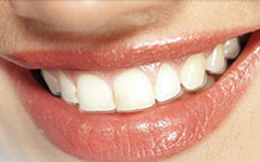 Invisalign System Invisalign System