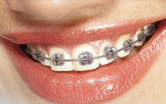 Metal Braces Metal Braces